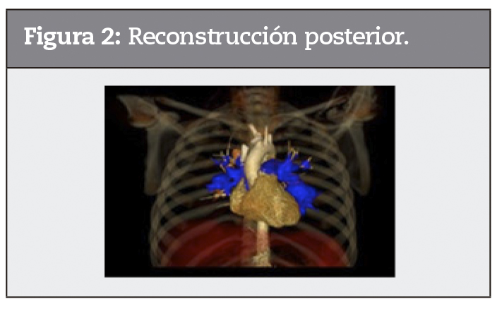 Reconstrucción posterior.