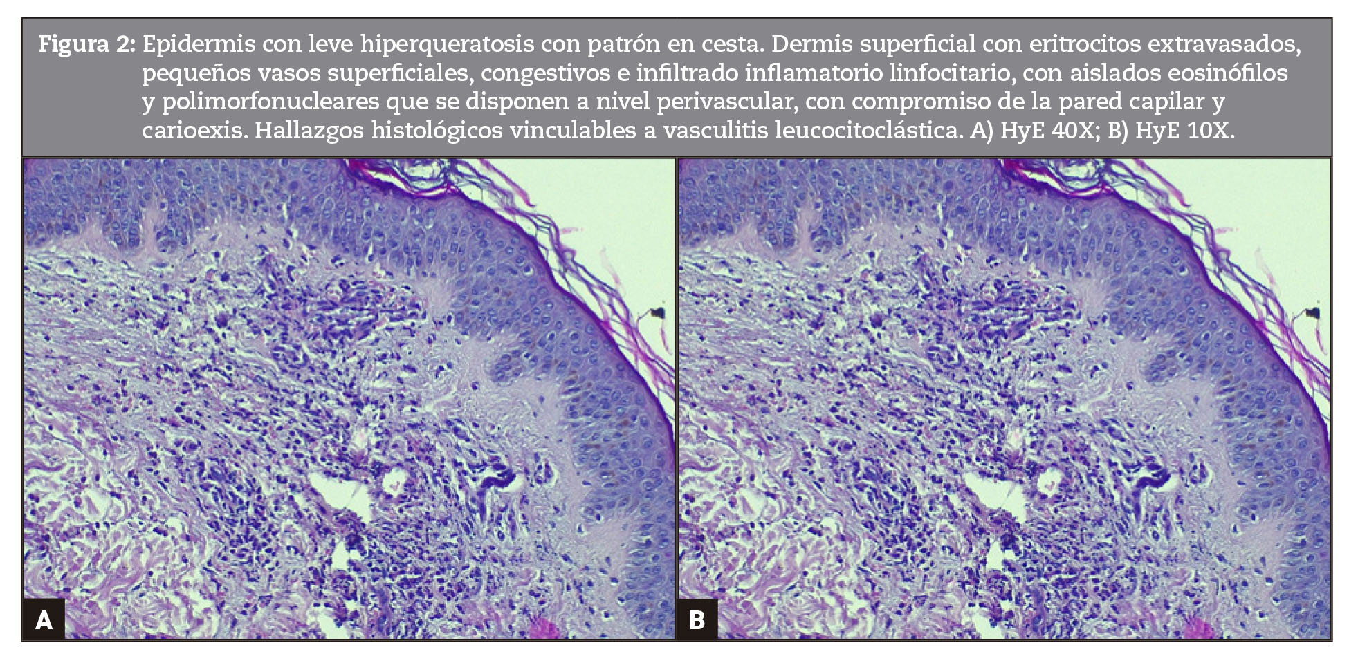 Epidermis con leve hiperqueratosis con patrón en cesta. Dermis superficial con eritrocitos extravasados, pequeños vasos superficiales, congestivos e infiltrado inflamatorio linfocitario, con aislados eosinófilos y polimorfonucleares que se disponen a nivel perivascular, con compromiso de la pared capilar y carioexis. Hallazgos histológicos vinculables a vasculitis leucocitoclástica. A) HyE 40X; B) HyE 10X.