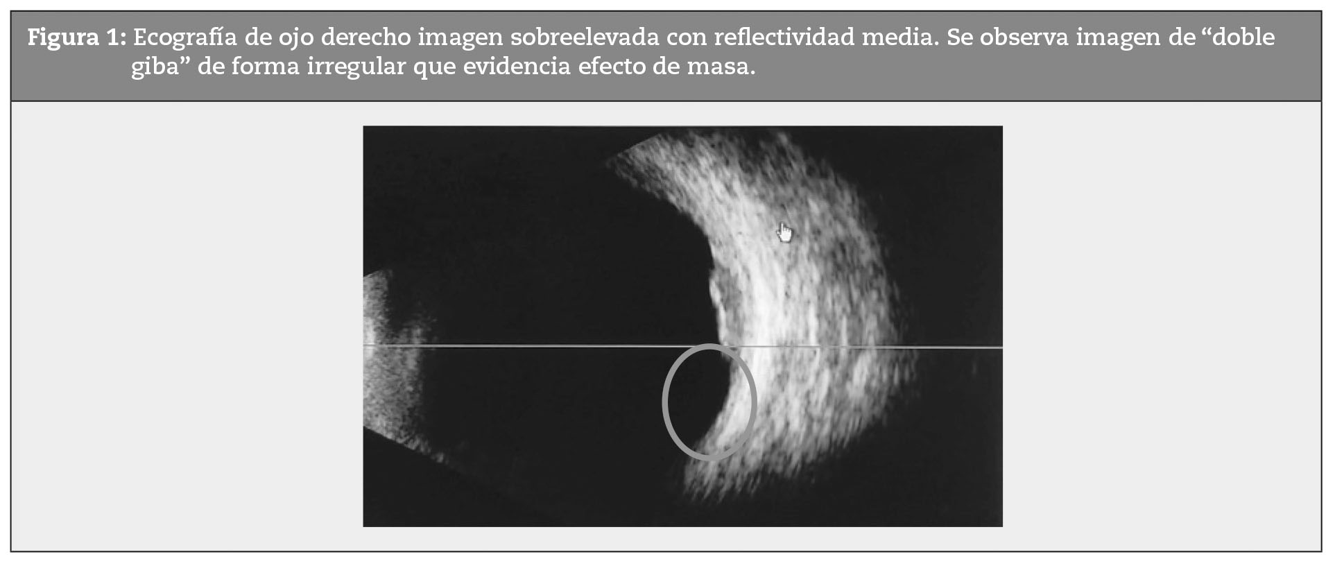 Ecografía de ojo derecho imagen sobreelevada con reflectividad media. Se observa imagen de “doble giba” de forma irregular que evidencia efecto de masa.