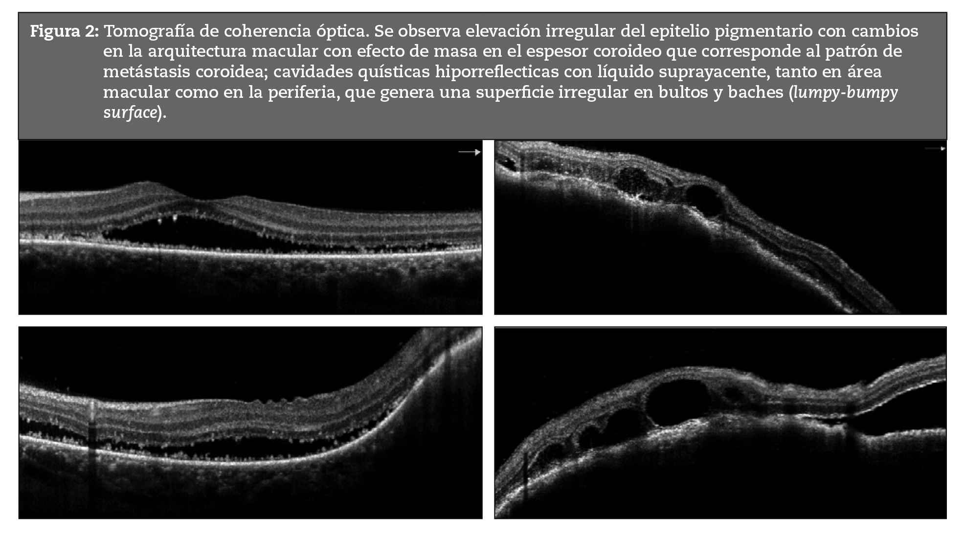 Tomografía de coherencia óptica. Se observa elevación irregular del epitelio pigmentario con cambios en la arquitectura macular con efecto de masa en el espesor coroideo que corresponde al patrón de metástasis coroidea; cavidades quísticas hiporreflecticas con líquido suprayacente, tanto en área macular como en la periferia, que genera una superficie irregular en bultos y baches (lumpy-bumpy surface).