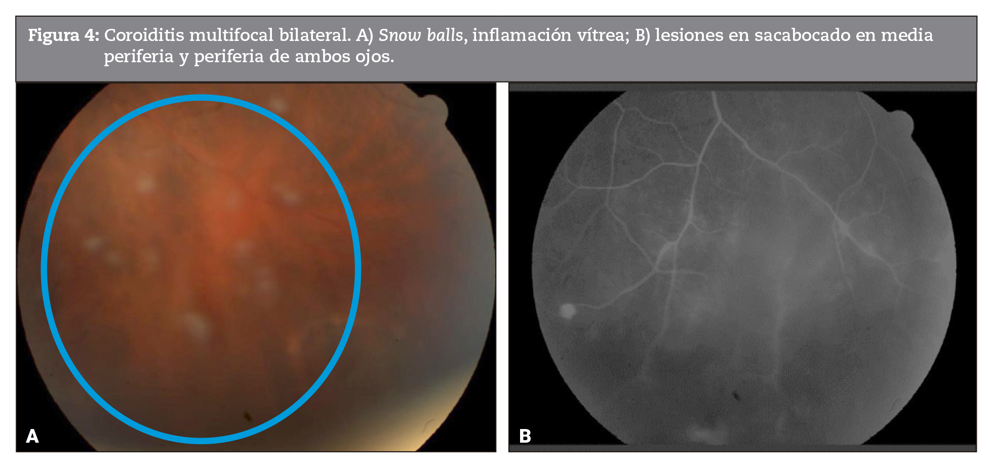 Coroiditis multifocal bilateral. A) Snow balls, inflamación vítrea; B) lesiones en sacabocado en media periferia y periferia de ambos ojos. 